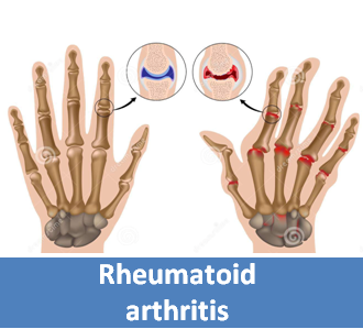 rheumatoid arthritis